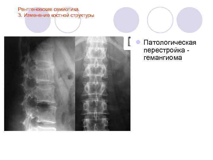 Рентгеновская семиотика. 3. Изменение костной структуры l Патологическая перестройка гемангиома 