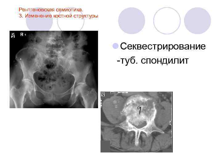 Рентгеновская семиотика. 3. Изменение костной структуры l Секвестрирование -туб. спондилит 
