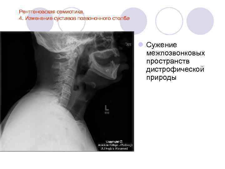 Рентгеновская семиотика. 4. Изменение суставов позвоночного столба l Сужение межпозвонковых пространств дистрофической природы 