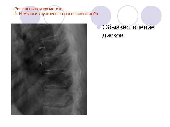 Обызвествления позвоночника