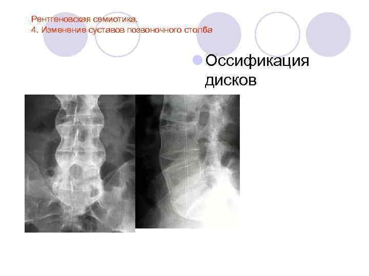 Рентгеновская семиотика. 4. Изменение суставов позвоночного столба l Оссификация дисков 