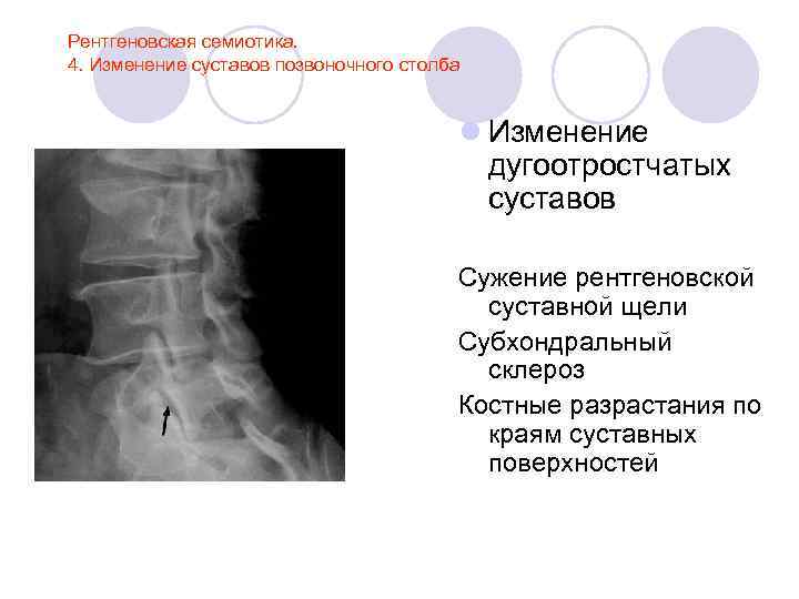 Межпозвоночный склероз. Позвоночно-дугоотросчатые суставы рентген. Суставная щель Крювелье. Дугоотросчатые суставы позвоночника рентген. Сужение суставных щелей межпозвонковых суставов.