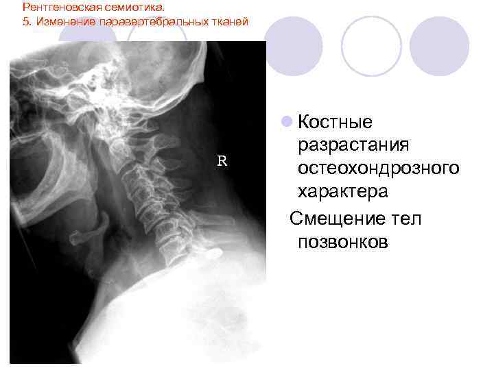 Рентгеновская семиотика. 5. Изменение паравертебральных тканей l Костные разрастания остеохондрозного характера Смещение тел позвонков