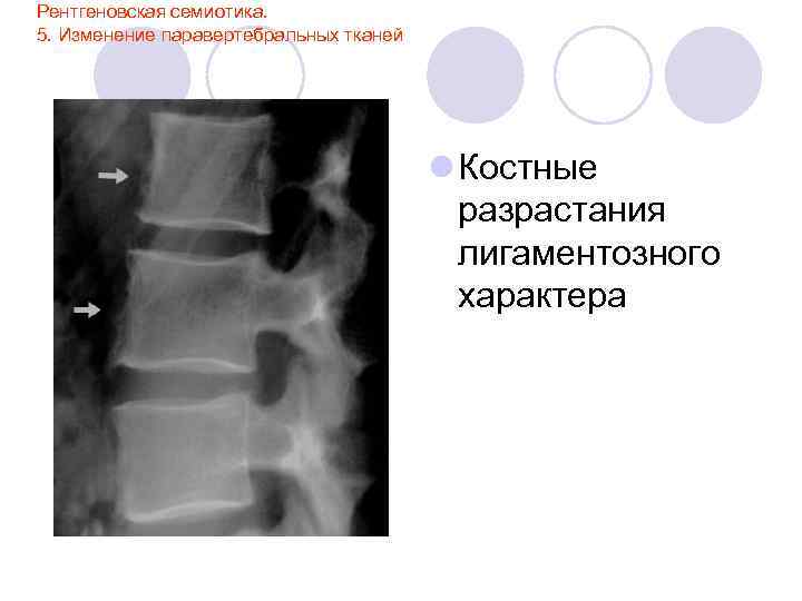 Рентгеновская семиотика. 5. Изменение паравертебральных тканей l Костные разрастания лигаментозного характера 