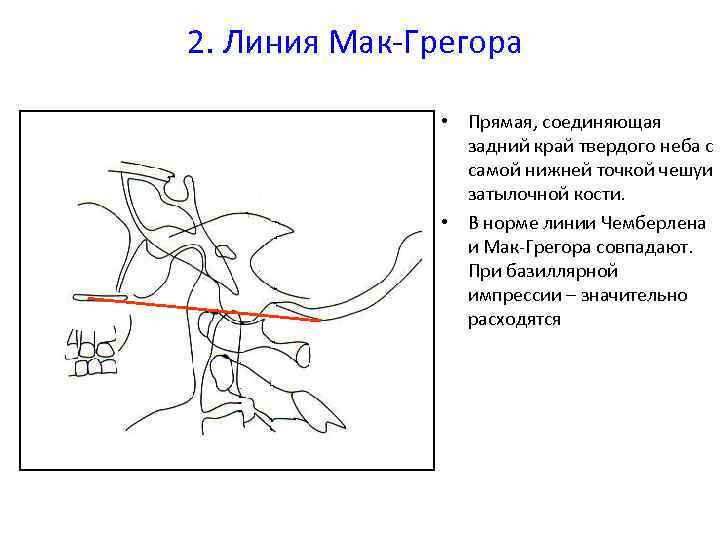 2. Линия Мак-Грегора • Прямая, соединяющая задний край твердого неба с самой нижней точкой