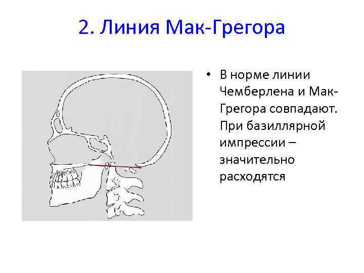 Мозжечок выше линии чемберлена