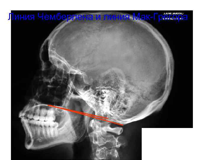 Линия Чемберлена и линия Мак-Грегора 