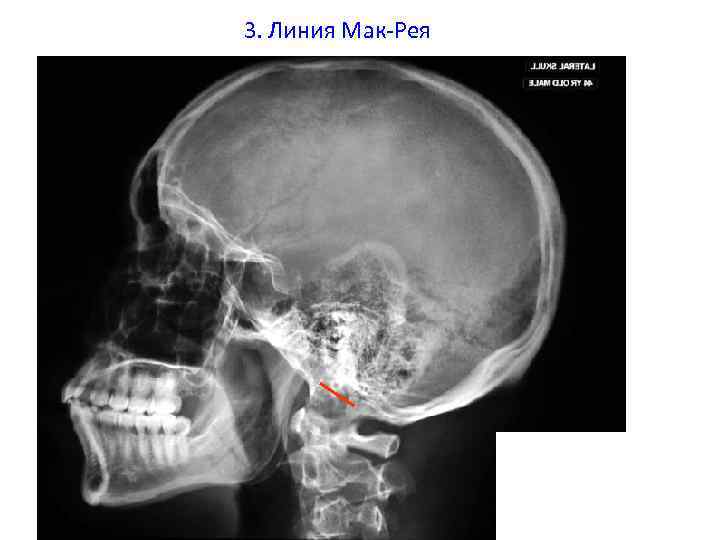 3. Линия Мак-Рея 