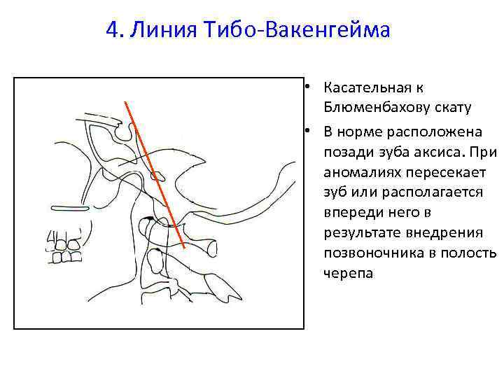 4. Линия Тибо-Вакенгейма • Касательная к Блюменбахову скату • В норме расположена позади зуба