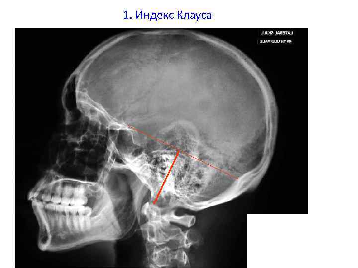 1. Индекс Клауса 