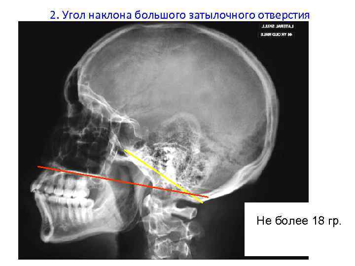 2. Угол наклона большого затылочного отверстия Не более 18 гр. 