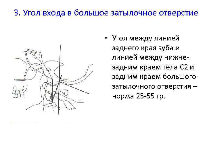 Угол отверстия. Угол входа в большое затылочное отверстие. Размер большого затылочного отверстия в норме. Передне-задний размер большого затылочного отверстия. Угол затылочного отверстия.