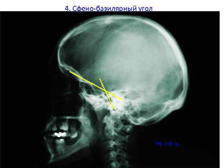 4. Сфено-базилярный угол 90 -130 гр. 