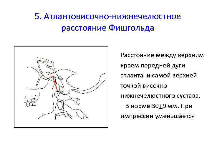 5. Атлантовисочно-нижнечелюстное расстояние Фишгольда Расстояние между верхним краем передней дуги атланта и самой верхней