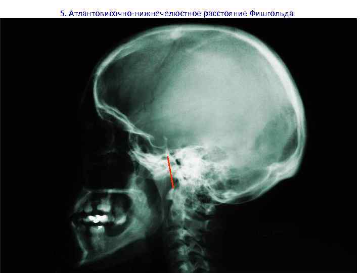 5. Атлантовисочно-нижнечелюстное расстояние Фишгольда 30+9 мм 
