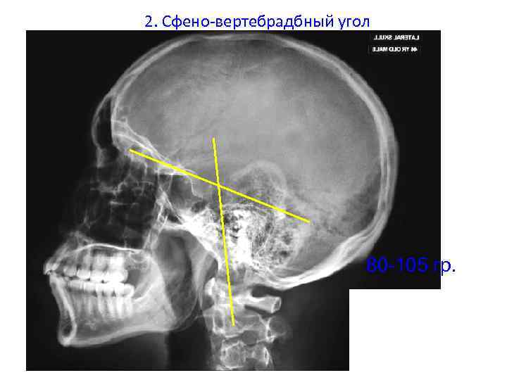 2. Сфено-вертебрадбный угол 80 -105 гр. 