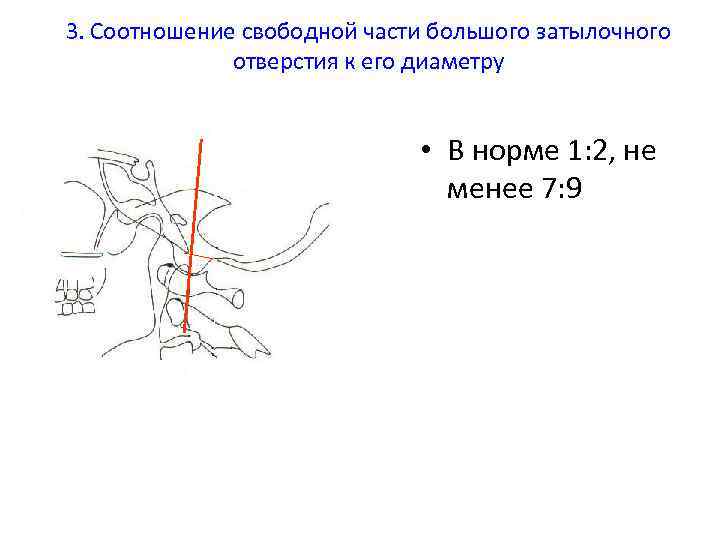 3. Соотношение свободной части большого затылочного отверстия к его диаметру • В норме 1: