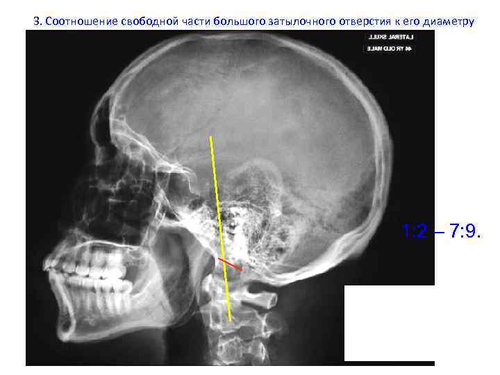 3. Соотношение свободной части большого затылочного отверстия к его диаметру 1: 2 – 7: