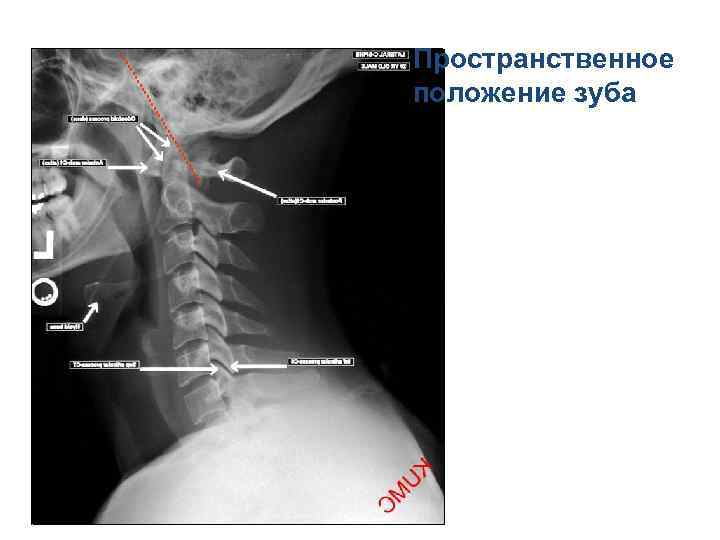 Пространственное положение зуба 