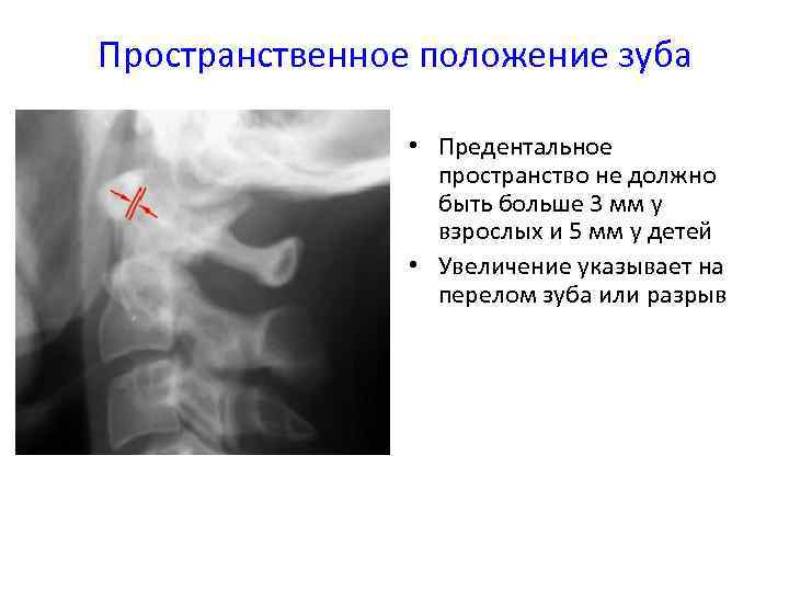 Пространственное положение зуба • Предентальное пространство не должно быть больше 3 мм у взрослых