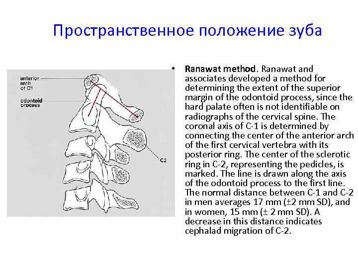 Пространственное положение зуба • Ranawat method. Ranawat and associates developed a method for determining