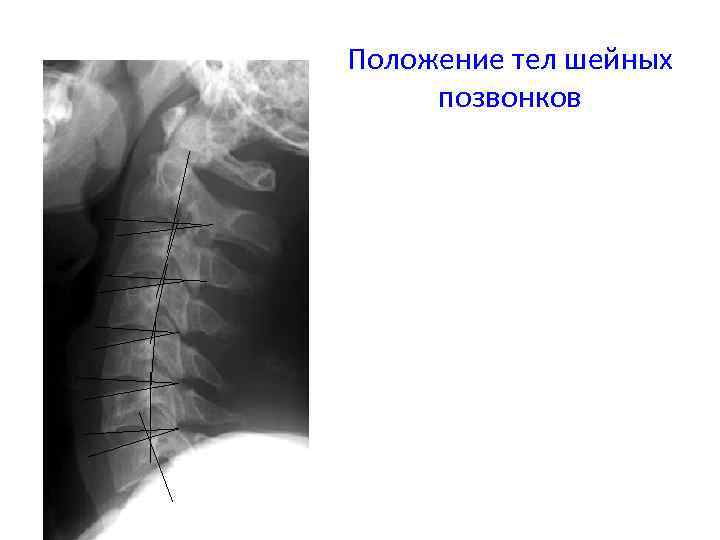 Положение тел шейных позвонков 