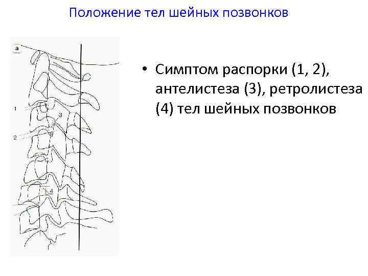 Положение тел шейных позвонков • Симптом распорки (1, 2), антелистеза (3), ретролистеза (4) тел