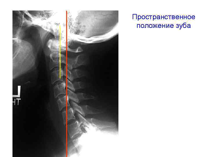 Пространственное положение зуба 