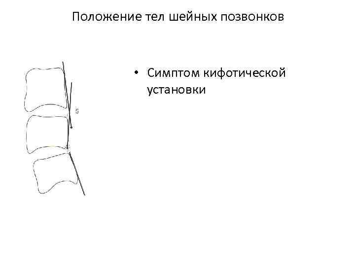 Положение тел шейных позвонков • Симптом кифотической установки 