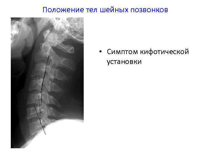 Кифотическая установка шейного отдела