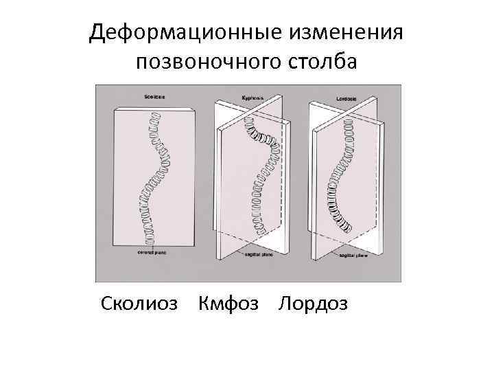 Деформационные изменения позвоночного столба Сколиоз Кмфоз Лордоз 