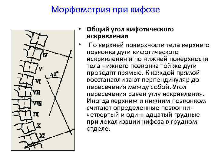 Степени кифоза позвоночника. Угол кифоза грудного отдела позвоночника. Грудной кифоз угол Кобба. Угол кифоза грудного отдела позвоночника в норме. Угол грудного кифоза норма.