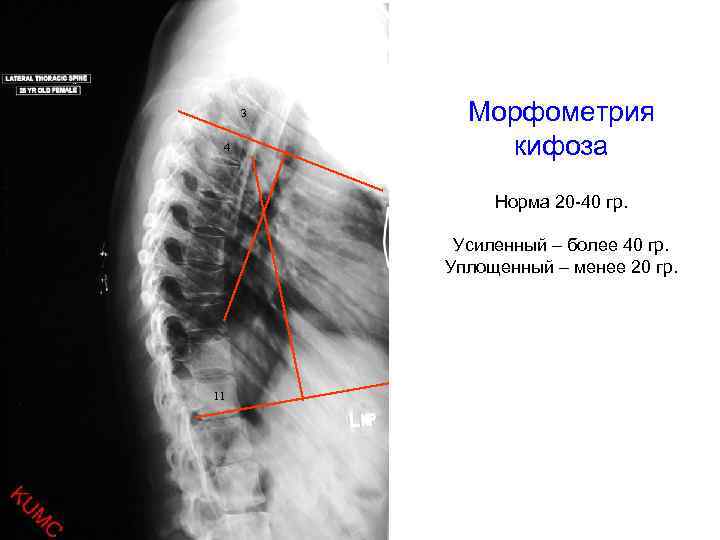 Кифоз степени фото