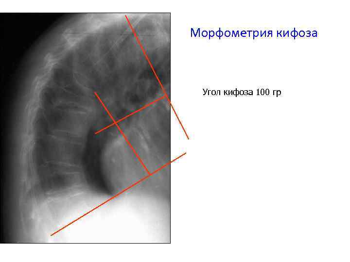 Морфометрия кифоза Угол кифоза 100 гр 