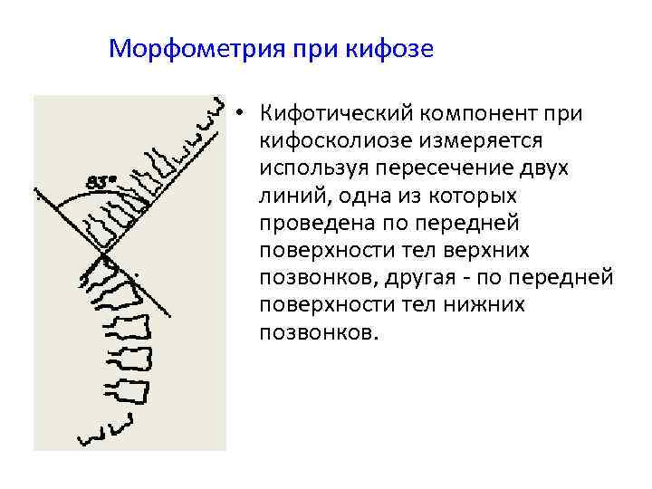 Морфометрия при кифозе • Кифотический компонент при кифосколиозе измеряется используя пересечение двух линий, одна