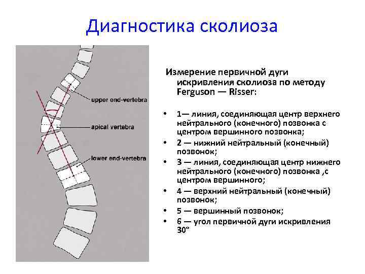 Угол кобба. Метод Кобба сколиоз степени. Степени искривления позвоночника по коббу. Измерение степени сколиоза по коббу. Сколиоз позвоночника по коббу.