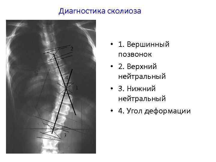 Диагностика сколиоза 2 4 1 3 • 1. Вершинный позвонок • 2. Верхний нейтральный