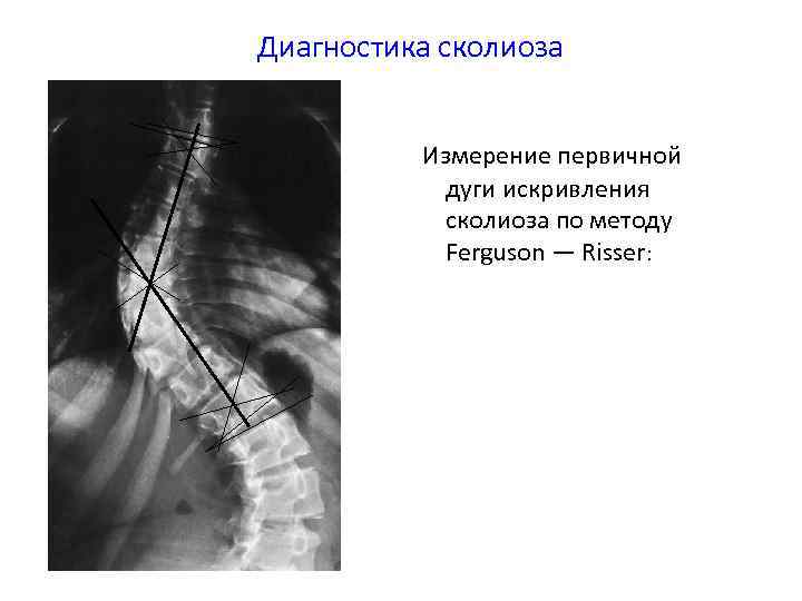 Диагностика сколиоза Измерение первичной дуги искривления сколиоза по методу Ferguson — Risser: 