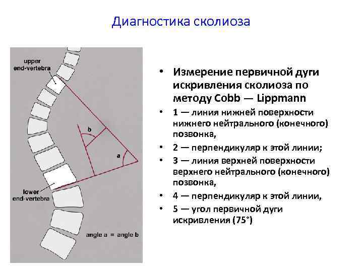 Угол кобба. Сколиоз по коббу степени рентген. Угол сколиоза по чаклину рентген. Метод Кобба сколиоз степени. Сколиотическая дуга метод Кобба степени.