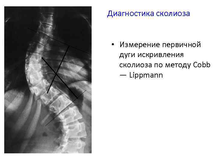 Диагностика сколиоза • Измерение первичной дуги искривления сколиоза по методу Cobb — Lippmann 