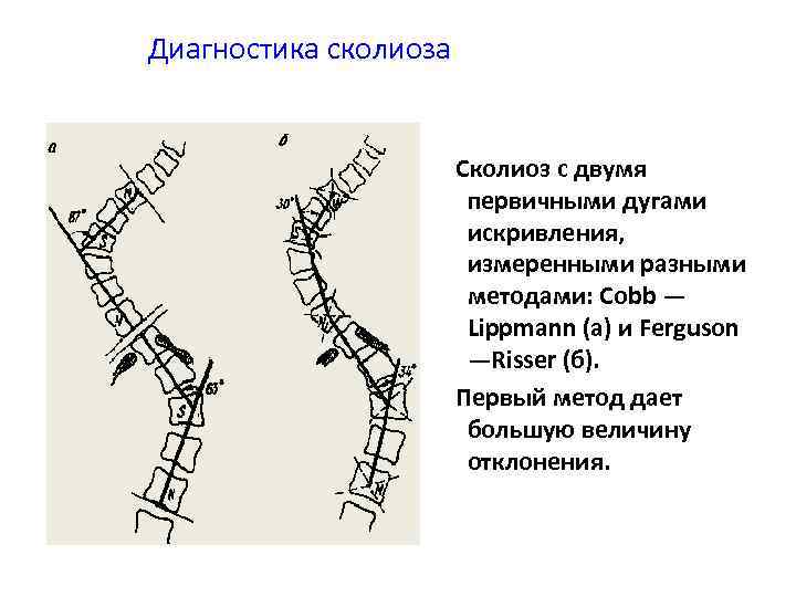 Диагностика сколиоза Сколиоз с двумя первичными дугами искривления, измеренными разными методами: Cobb — Lippmann