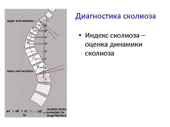Диагностика сколиоза • Индекс сколиоза – оценка динамики сколиоза 