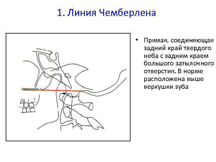 1. Линия Чемберлена • Прямая, соединяющая задний край твердого неба с задним краем большого
