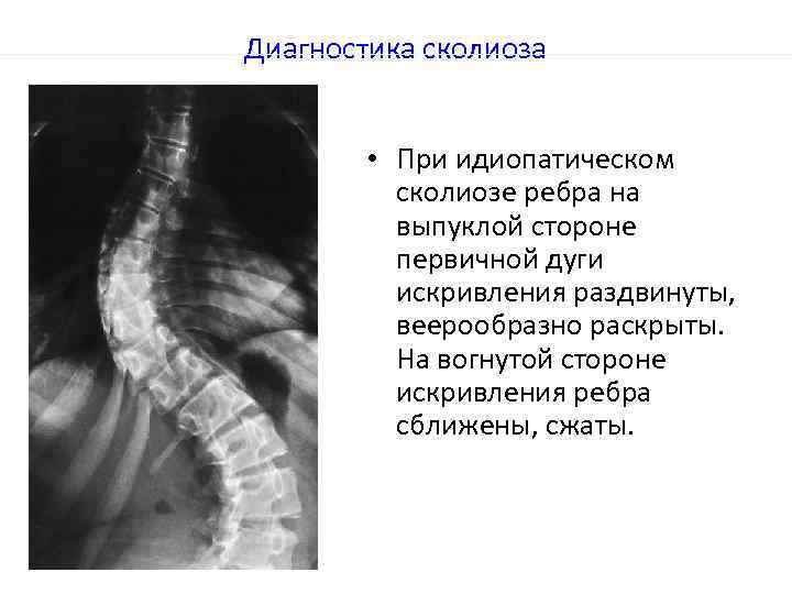 Диагностика сколиоза • При идиопатическом сколиозе ребра на выпуклой стороне первичной дуги искривления раздвинуты,