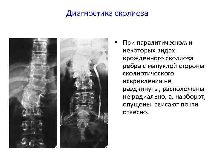 Диагностика сколиоза • При паралитическом и некоторых видах врожденного сколиоза ребра с выпуклой стороны