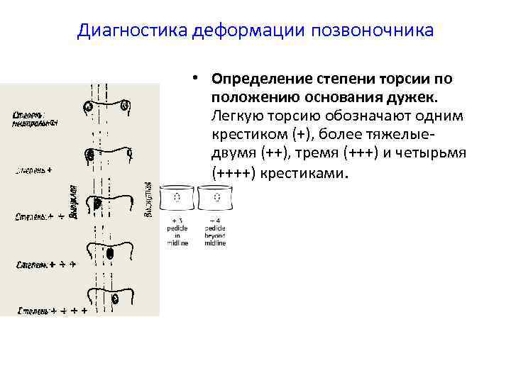 Диагностика деформации позвоночника • Определение степени торсии по положению основания дужек. Легкую торсию обозначают