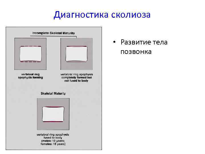 Диагностика сколиоза • Развитие тела позвонка 