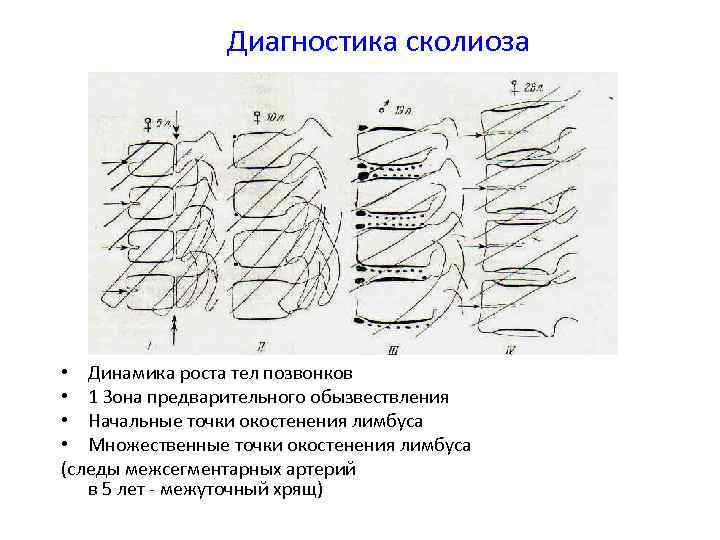 Диагностика сколиоза • Динамика роста тел позвонков • 1 Зона предварительного обызвествления • Начальные