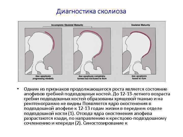 Диагностика сколиоза • Одним из признаков продолжающегося роста является состояние апофизов гребней подвздошных костей.