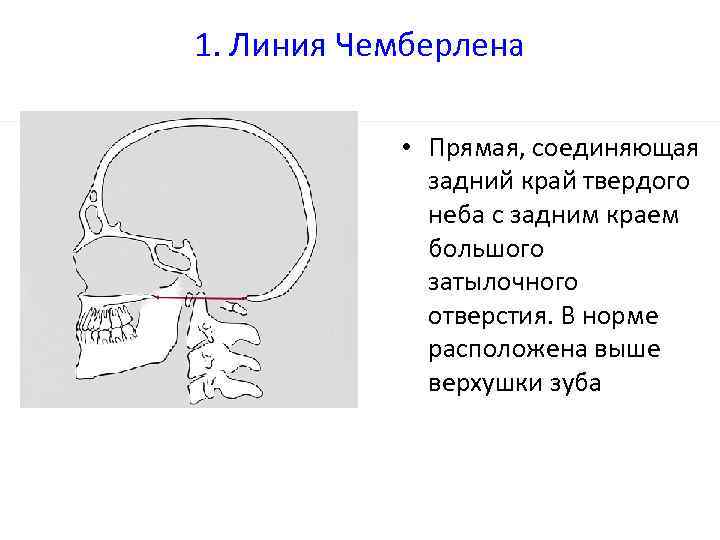 Мозжечок выше линии чемберлена